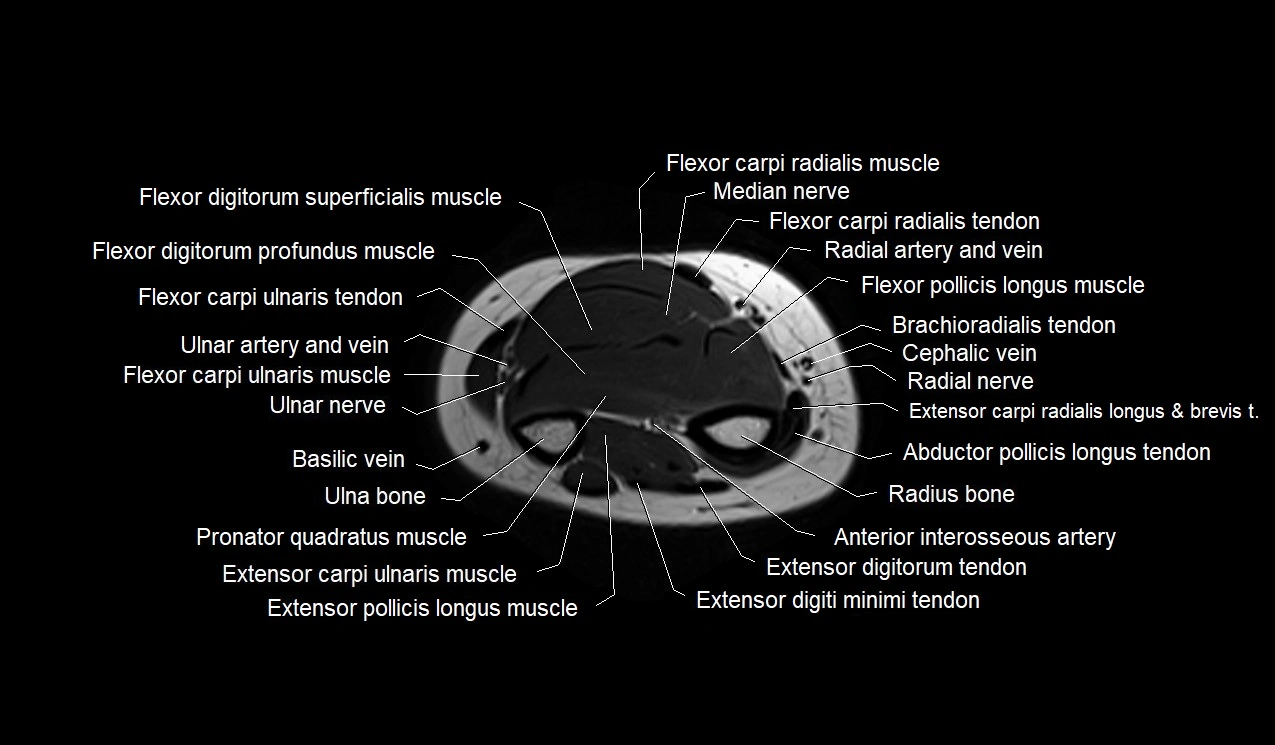 MRI 3T forearm axial cross sectional anatomy image 38.webp